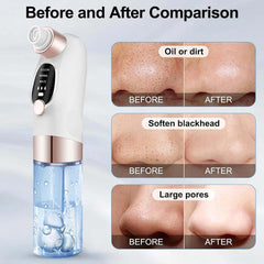 Blackhead Suction Remover Vacuum Pore Cleaner. Electric facial tool for deep cleaning blackheads & unclogging pores. Waterproof.